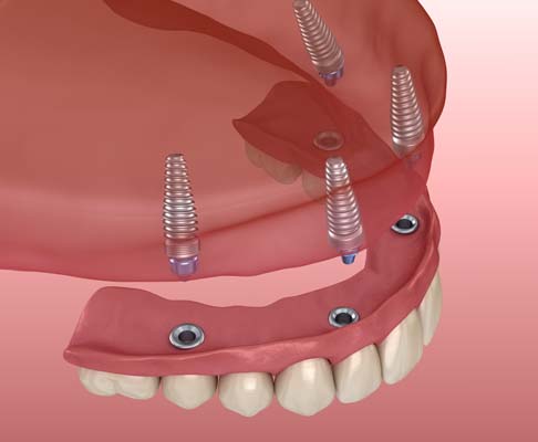 How Long Do All On   Implants Last?