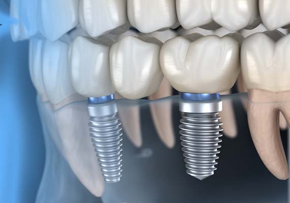 Tooth Replacement: Dentures Or Dental Implants?