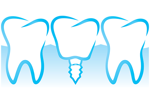 Dental Implant Restoration Big Stone Gap, VA