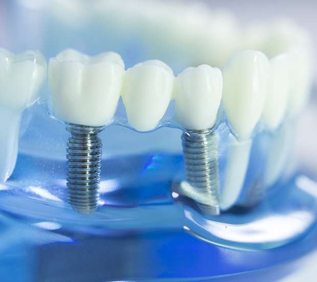 Big Stone Gap Dental Implants