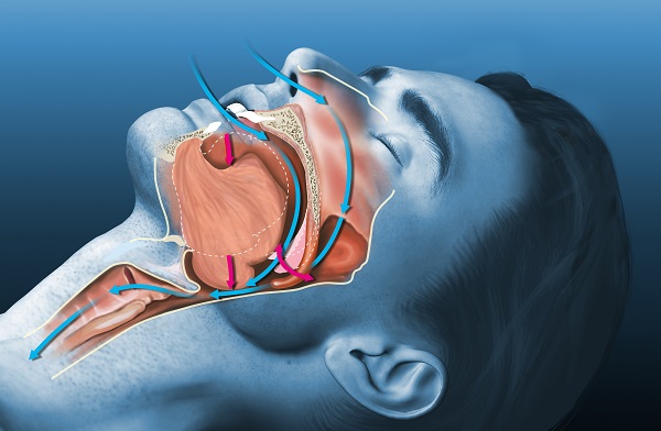 What Devices Do Dentists Recommend For Sleep Apnea?