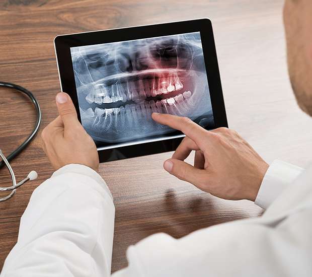 Big Stone Gap Types of Dental Root Fractures